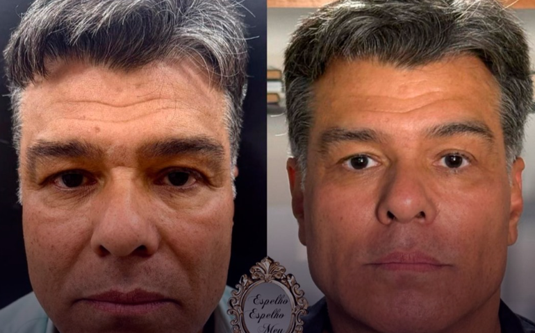 Mauricio Mattar passa por harmonização facial e mostra resultado; compare