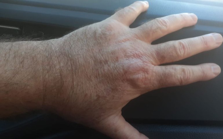 Pesquisadores descobrem variante resistente da leishmaniose no Brasil