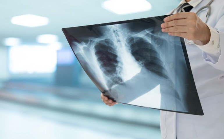 Comissão debate a formulação de políticas públicas para pessoas com hipertensão pulmonar crônica