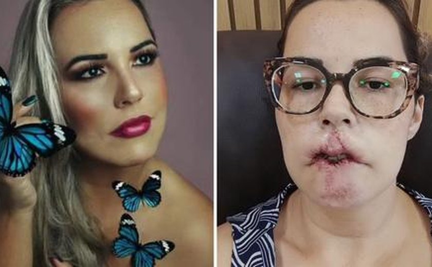 Mulher perde lábio superior após realizar preenchimento labial e harmonização com PMMA