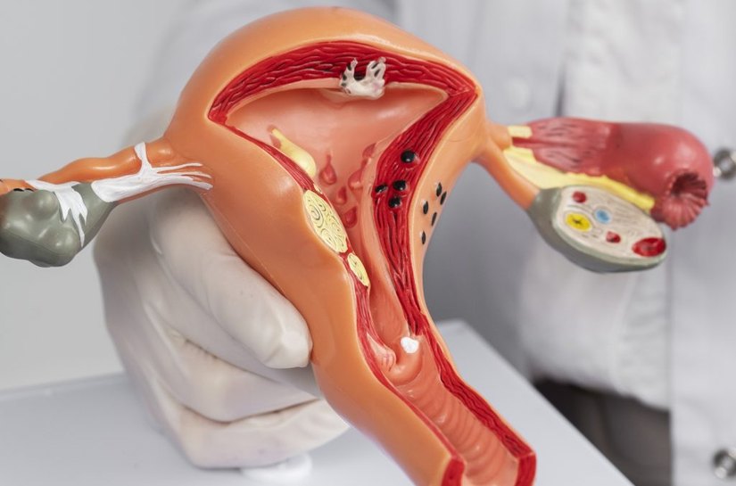 Santa Casa amplia assistência à saúde da mulher com exames para endometriose