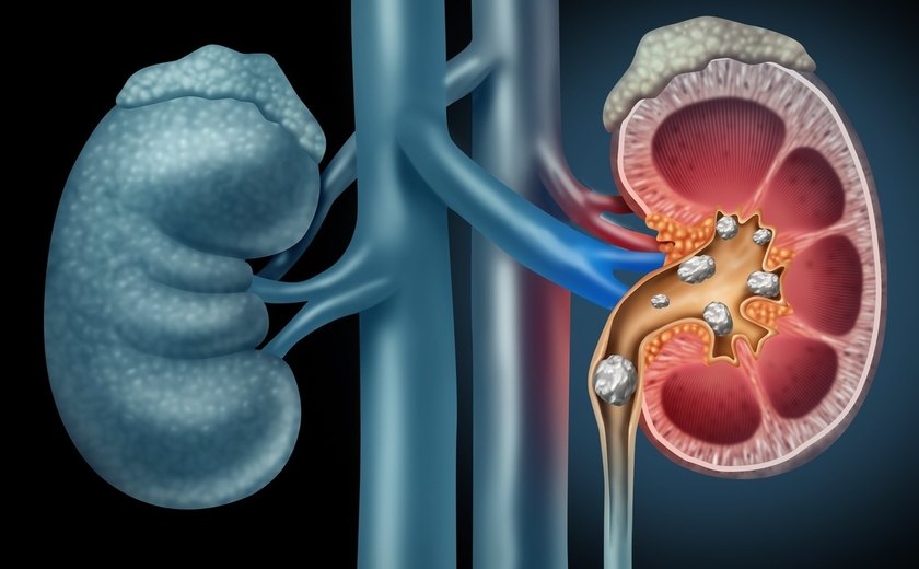 Danos aos rins? Cálculos renais? Entenda efeitos das bebidas com gás no seu corpo