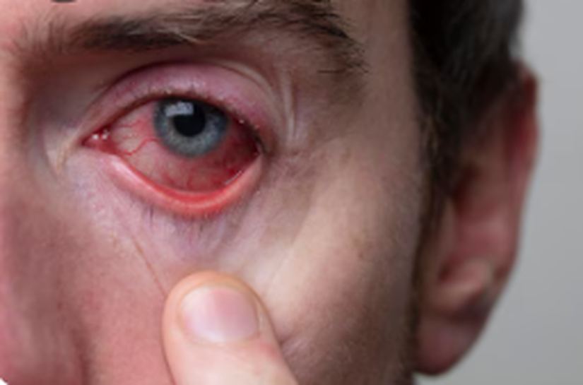 Quase 30% dos atendimentos de urgência oftalmológica no H.Olhos são por conjuntivite