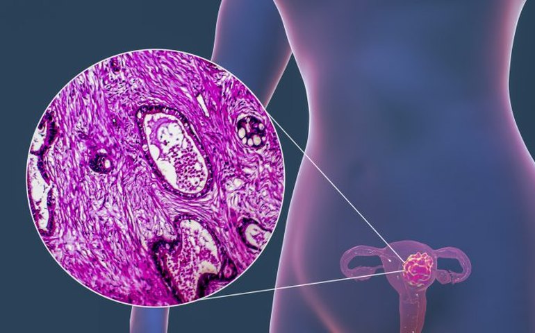 Câncer de colo de útero: teste molecular de HPV, que vai substituir Papanicolau no SUS, identifica quase 4 vezes mais casos da infecção