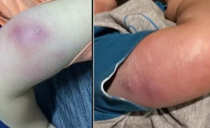 Menino de 1 ano é internado com infecção grave após vacina
