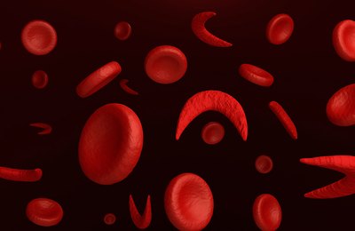 Doença falciforme: é possível ter longevidade e qualidade de vida?