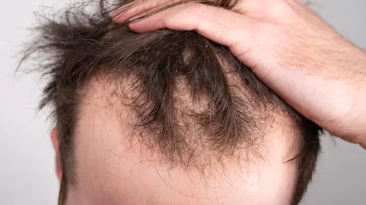 Por que o estresse pode causar queda de cabelo: como ele afeta o couro cabeludo