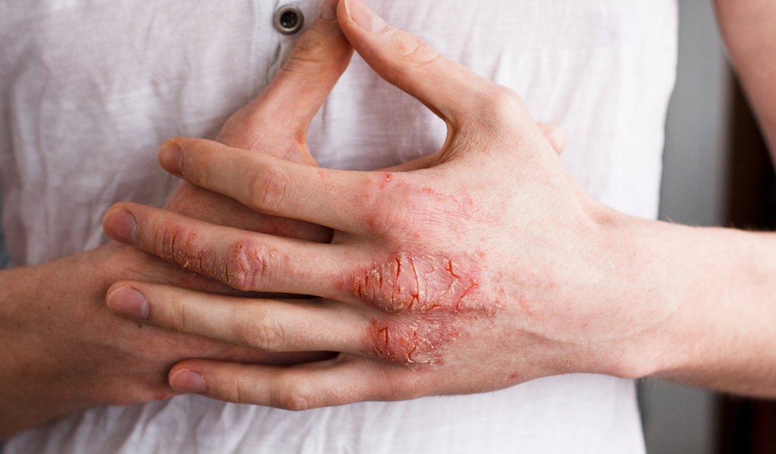 Anvisa aprova novo tratamento para dermatite atópica