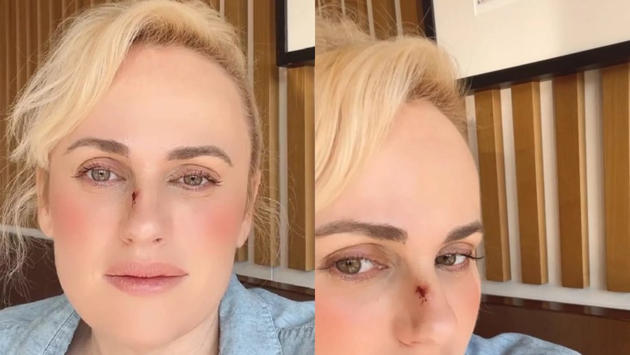 Rebel Wilson e o acidente no filme 'Bride Hard' que exigiu cirurgia
