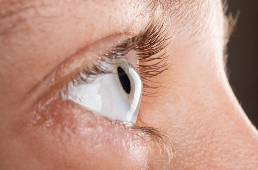 Fatores de risco para o Ceratocone, entre eles coçar os olhos