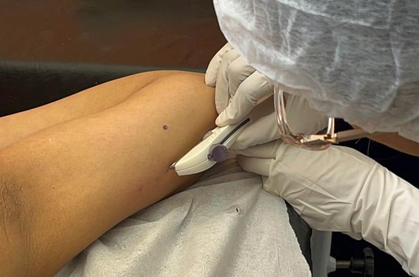 Secretaria da Primeira Infância promove capacitação para inserção do Implanon em Rio Largo