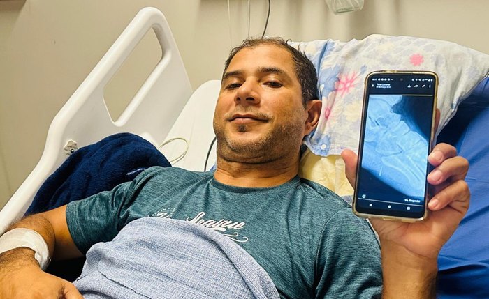 Ferrão ficou alojado no pé durante pescaria em praia