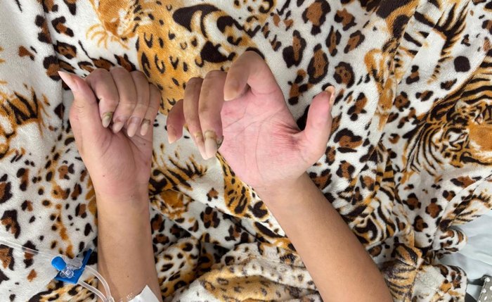 Paciente de 20 anos se recupera após diagnóstico de endocardite ligada às unhas em gel