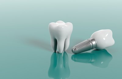 Implante dentário: entenda por que é um procedimento seguro