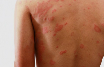 Saúde reforça alerta sobre sinais e sintomas da Hanseníase