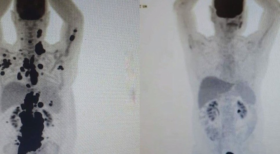 car-t-cancer-30052023110413730 / Foto: Portal R7
