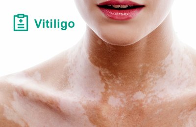 Dia Mundial do Vitiligo: médica do TJAL orienta sobre a doença