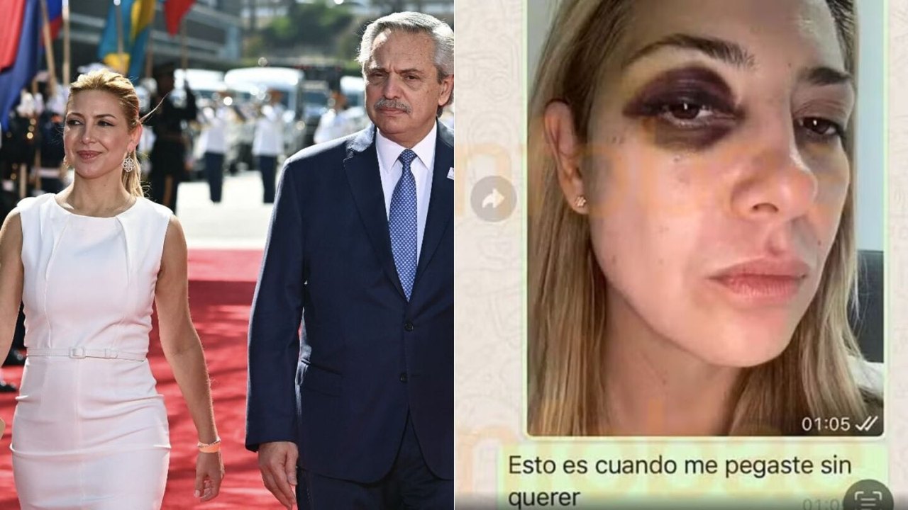 Fotos de ex-primeira-dama da Argentina com olho roxo e hematomas são reveladas após denúncia contra Fernández