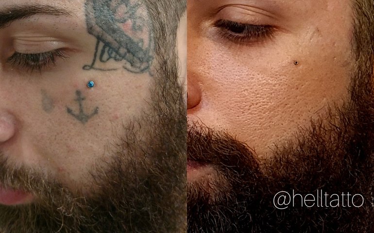 Especialista fala sobre cuidados para a remoção de tatuagens