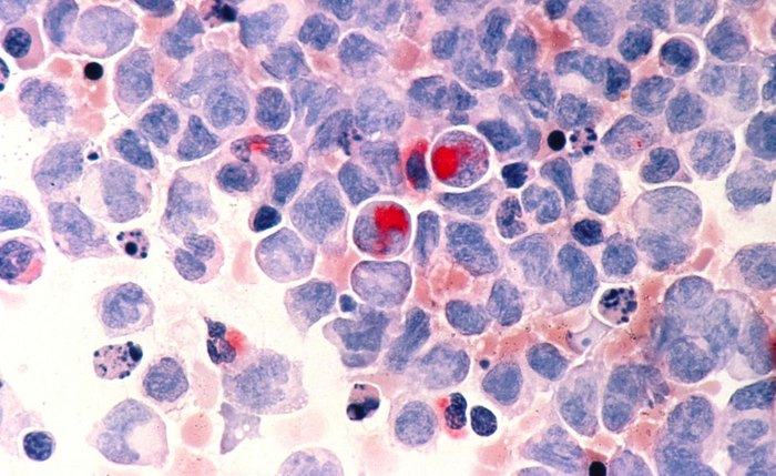Desenvolvida na Suíça, terapia ajudará pacientes com câncer de sangue