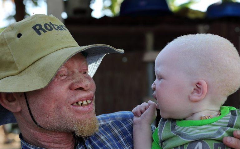Comissão de Educação debate criação do Dia Nacional de Conscientização sobre o Albinismo