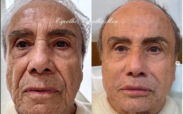 Stênio Garcia diz que harmonização faz parte do desejo em voltar a trabalhar