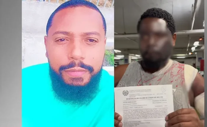 Homem tem rosto deformado após mulher jogar água quente enquanto ele dormia