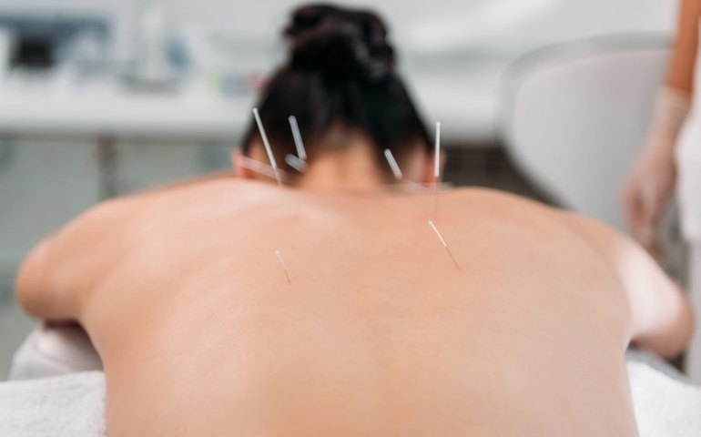 Lei regulamenta exercício profissional da acupuntura