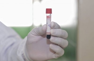 Palmeira já testou 571 pessoas de Covid-19
