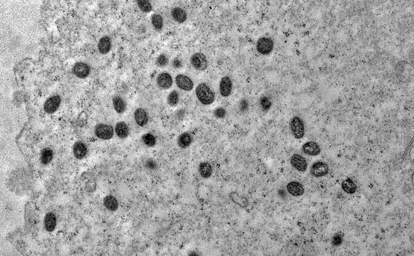 Pesquisa indica risco de monkeypox agravar infeccão por HIV