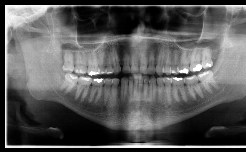 Corpo de enfermeiro do Mato Grosso é identificado após exame de odontologia legal