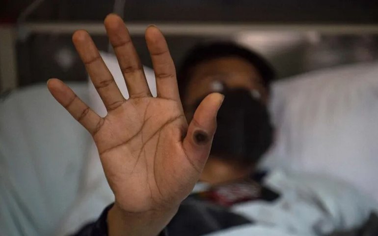 Mpox: qual a real letalidade da nova cepa? Entenda por que é difícil avaliar o perigo da doença