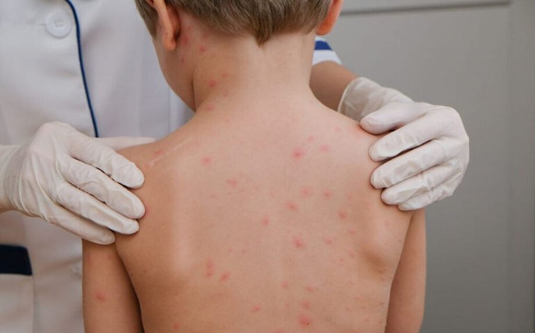 Mato Grosso registra 29 casos e 8 mortes por meningite em 2026; Saúde descarta surto