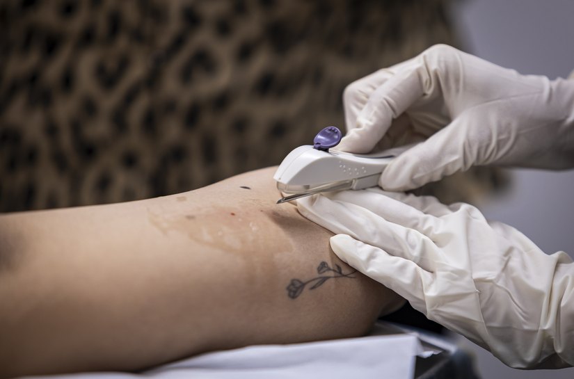 Em dois meses, Implanon é disponibilizado para mais de 600 mulheres