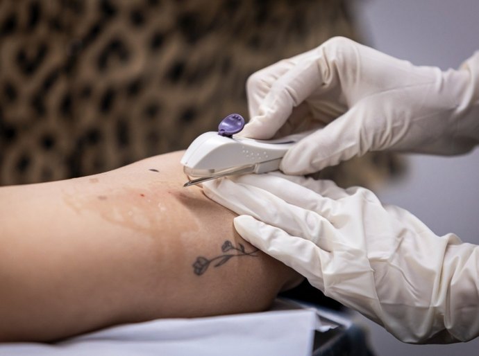 Gestão JHC marca avanço histórico na saúde da mulher com inserção gratuita do Implanon