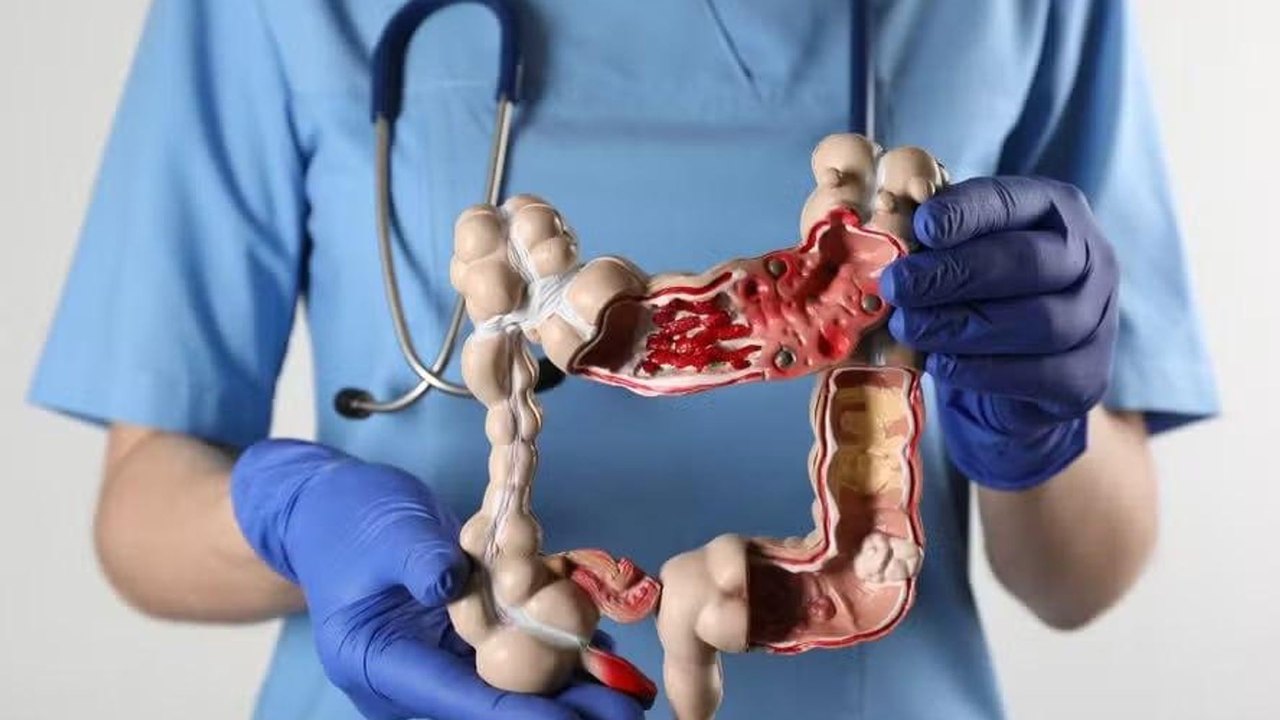 Casos de doenças inflamatórias intestinais aumentam mais de cinco vezes no Brasil