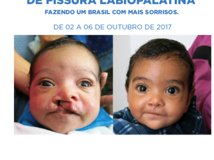 Campanha para correção do lábio leporino quer ampliar ações nos municípios