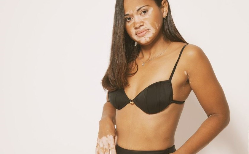 Mulheres com Vitiligo e PcD quebram barreiras e se tornarem modelos de moda praia