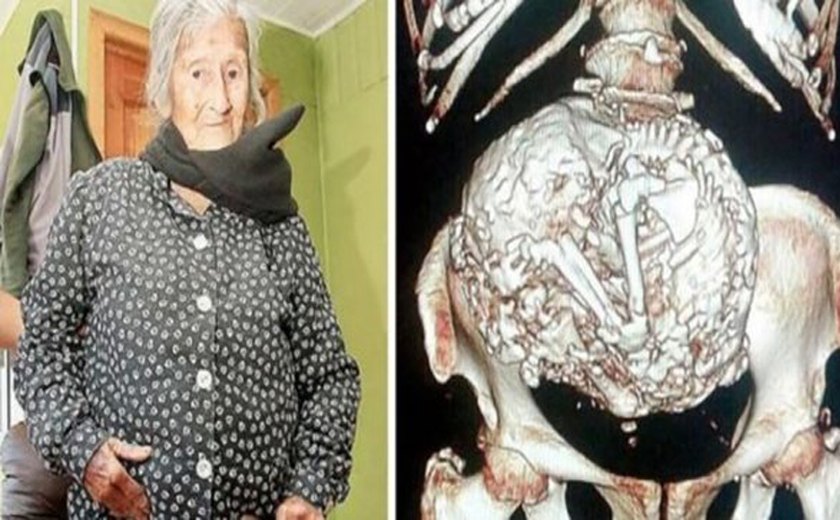 Senhora de 110 anos descobre que carrega feto calcificado há seis décadas