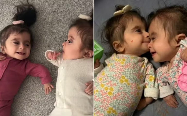 Gêmeas idênticas vivem com forma letal dos 'ossos de vidro'; veja vídeo e entenda o caso