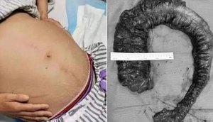 Médicos retiram 20 kg de fezes 'semelhante a píton' do intestino de mulher