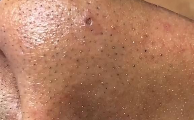 Usa fita adesiva para remover cravos do nariz? Essa pode não ser a melhor estratégia; entenda