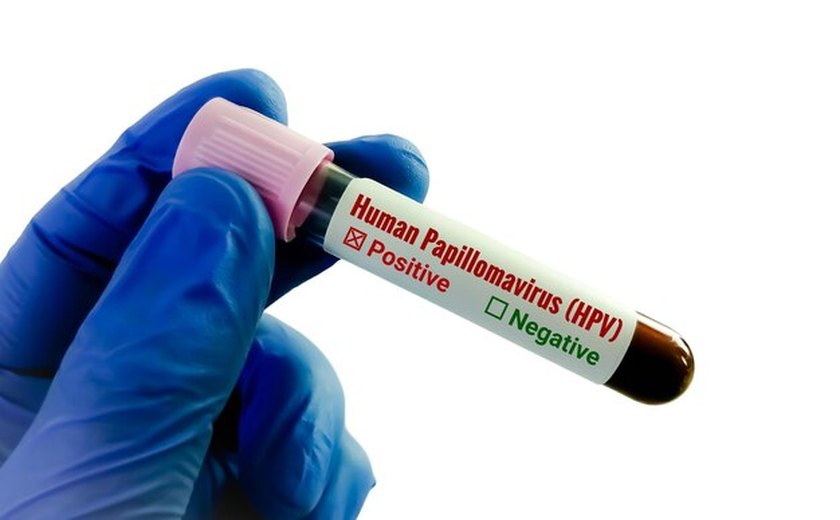 Testagem molecular para Câncer de Colo de Útero é prioridade nacional