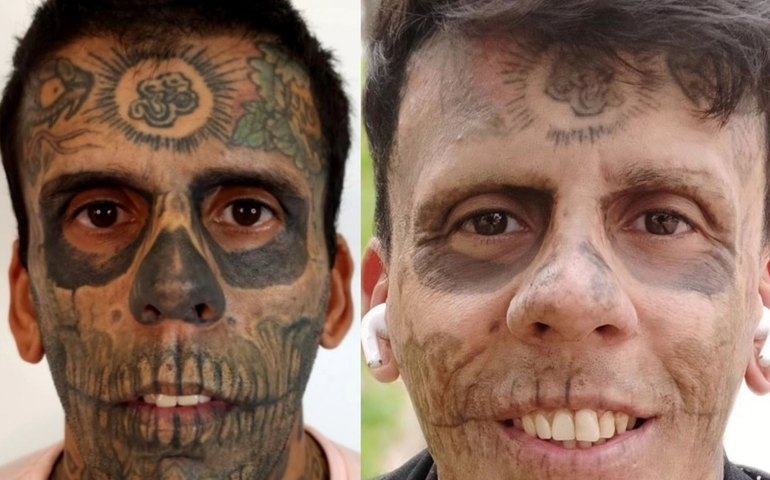 Homem 'mais tatuado do Brasil' começa a remover tatuagens: mas é possível ficar sem as marcas na pele? Dermatologista explica