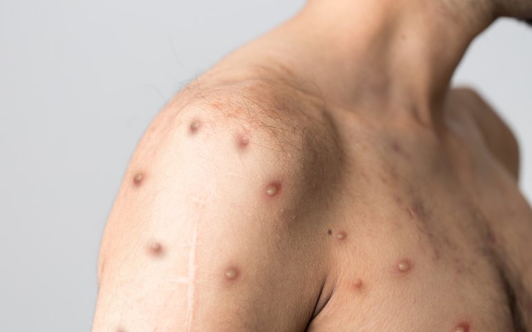 Sintomas, gravidade, transmissão por sexo, vacina: especialistas tiram as dúvidas sobre a nova cepa mais letal da Mpox 
