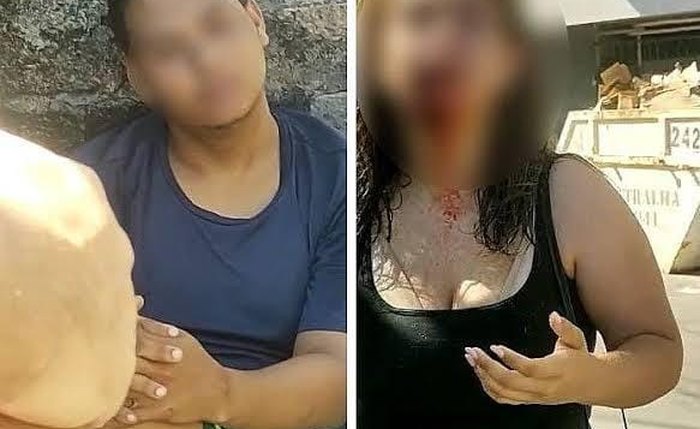 Turista teve parte do rosto rasgada em mordida durante tentativa de assalto