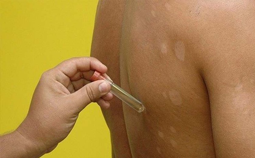 Saúde reforça cooperação técnica para frear casos de hanseníase em Rio Largo