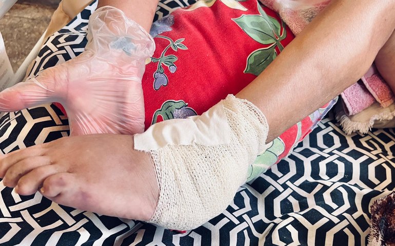 Especialistas do Hospital Dr. Ib Gatto atuam para prevenir úlceras por pressão em pacientes