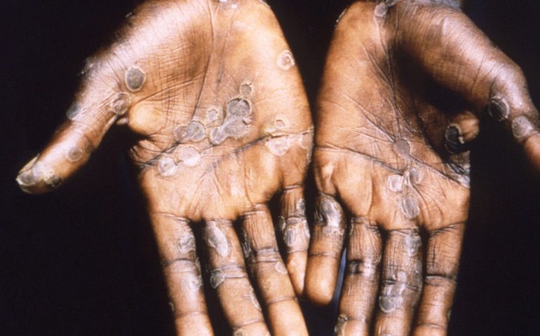 Mpox: por que faltam vacinas nos países mais afetados pela doença na África? Entenda