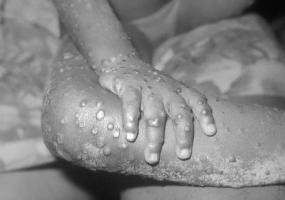 São Paulo: Ministério confirma mais um caso de varíola dos macacos no país